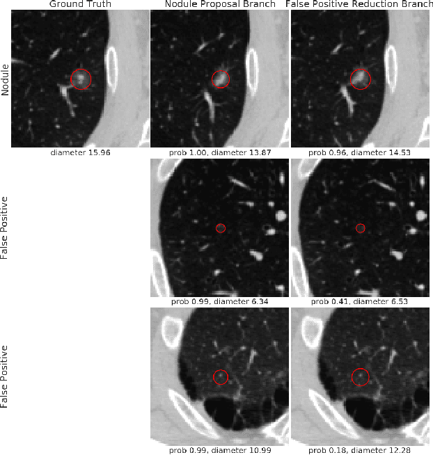 Figure 4 for An End-to-end Framework For Integrated Pulmonary Nodule Detection and False Positive Reduction