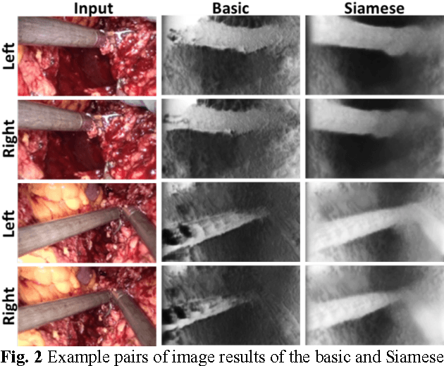 Figure 3 for Self-Supervised Siamese Learning on Stereo Image Pairs for Depth Estimation in Robotic Surgery