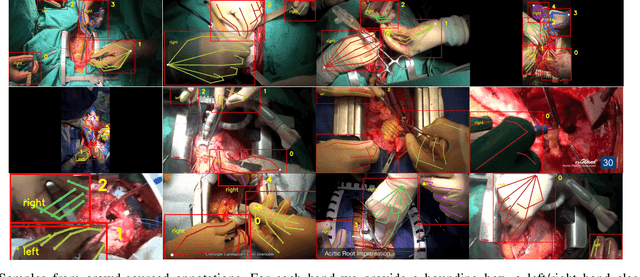 Figure 3 for Temporally Guided Articulated Hand Pose Tracking in Surgical Videos