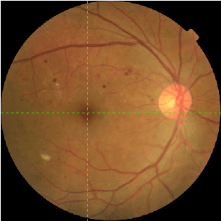 Figure 2 for Mini Lesions Detection on Diabetic Retinopathy Images via Large Scale CNN Features
