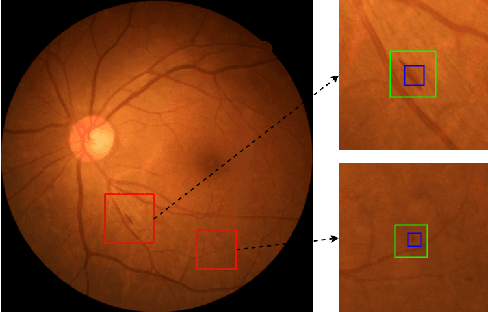 Figure 4 for Mini Lesions Detection on Diabetic Retinopathy Images via Large Scale CNN Features
