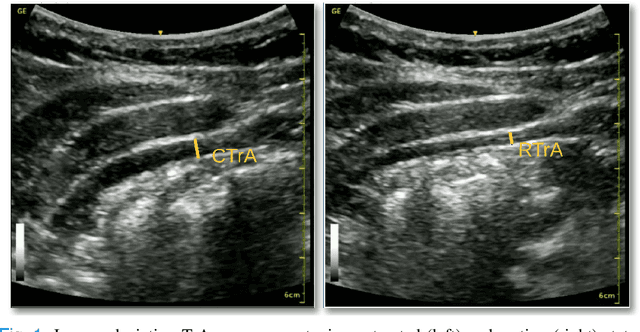 Figure 1 for A Deep Learning Localization Method for Measuring Abdominal Muscle Dimensions in Ultrasound Images