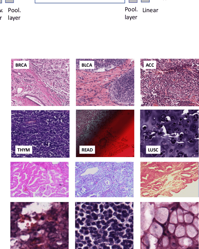 Figure 4 for Fine-Tuning and Training of DenseNet for Histopathology Image Representation Using TCGA Diagnostic Slides