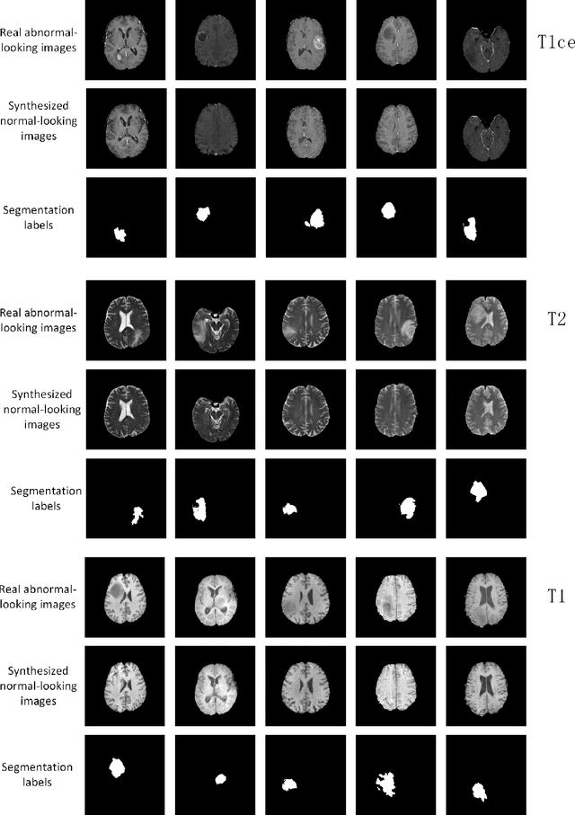Figure 2 for An Adversarial Learning Approach to Medical Image Synthesis for Lesion Removal