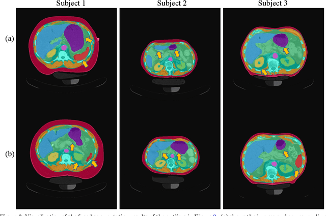 Figure 4 for Longitudinal Variability Analysis on Low-dose Abdominal CT with Deep Learning-based Segmentation