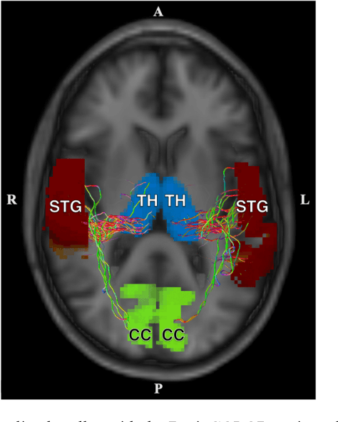 Figure 2 for MRI correlates of chronic symptoms in mild traumatic brain injury