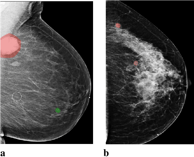 Figure 1 for Reducing false-positive biopsies with deep neural networks that utilize local and global information in screening mammograms