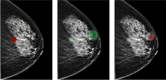Figure 3 for Reducing false-positive biopsies with deep neural networks that utilize local and global information in screening mammograms
