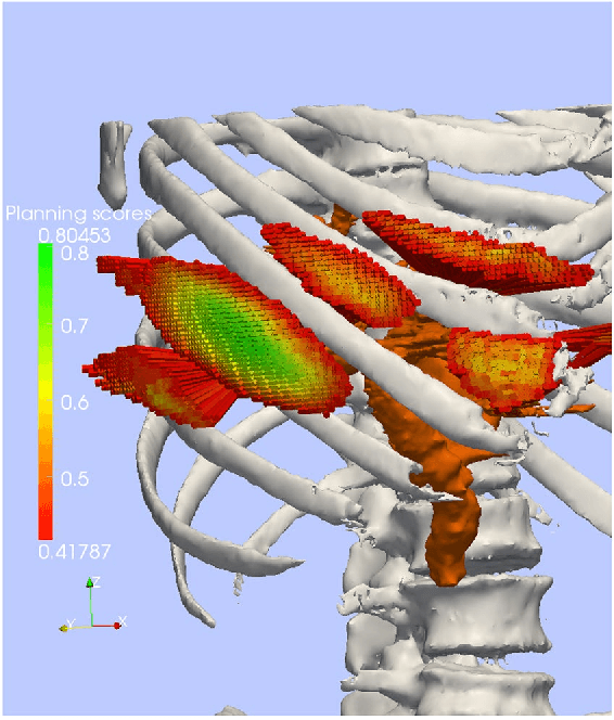 Figure 4 for Evaluation of Direct Haptic 4D Volume Rendering of Partially Segmented Data for Liver Puncture Simulation