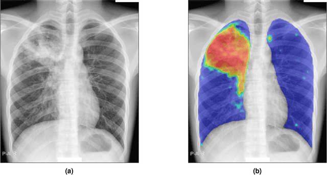 Figure 2 for Computer aided detection of tuberculosis on chest radiographs: An evaluation of the CAD4TB v6 system