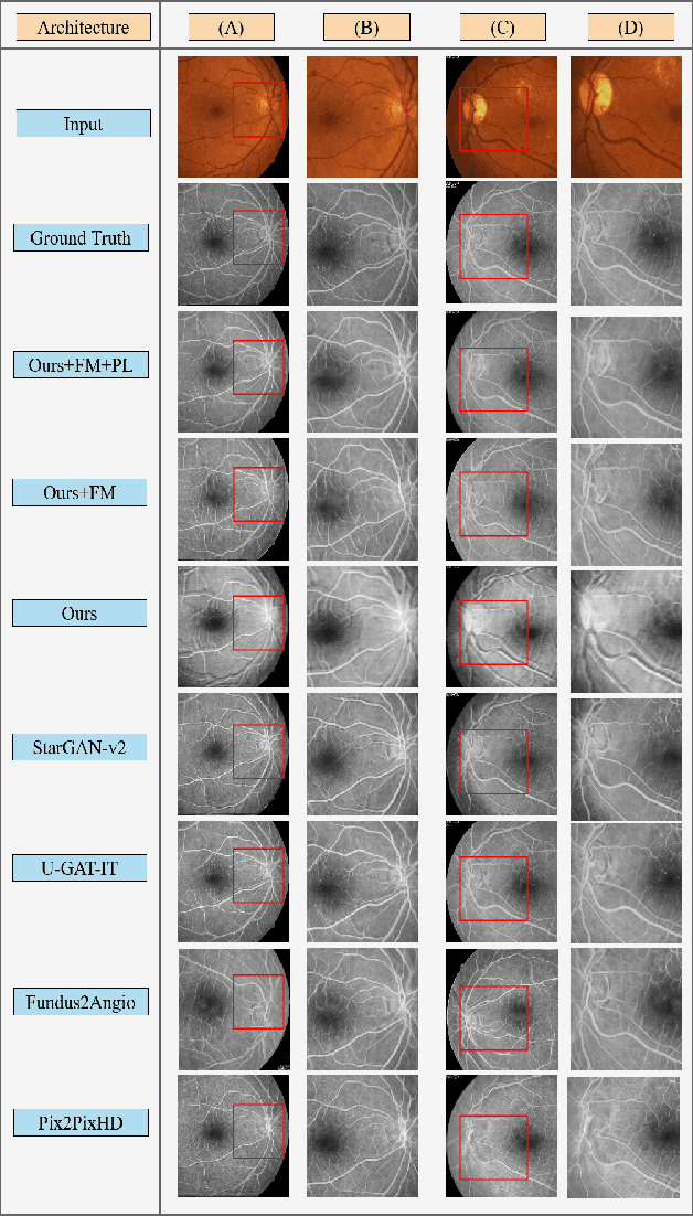 Figure 3 for Attention2AngioGAN: Synthesizing Fluorescein Angiography from Retinal Fundus Images using Generative Adversarial Networks
