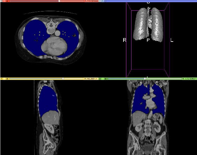 Figure 1 for CT organ segmentation using GPU data augmentation, unsupervised labels and IOU loss
