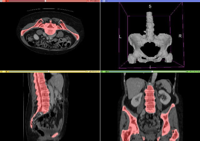 Figure 2 for CT organ segmentation using GPU data augmentation, unsupervised labels and IOU loss