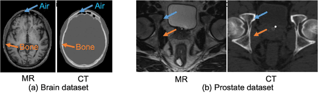 Figure 1 for Deep Embedding Convolutional Neural Network for Synthesizing CT Image from T1-Weighted MR Image