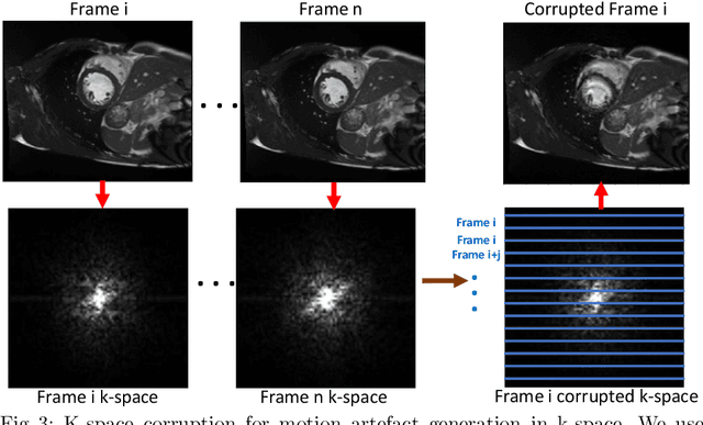 Figure 4 for Deep Learning using K-space Based Data Augmentation for Automated Cardiac MR Motion Artefact Detection