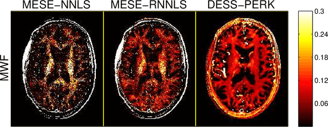 Figure 4 for Fast, Precise Myelin Water Quantification using DESS MRI and Kernel Learning
