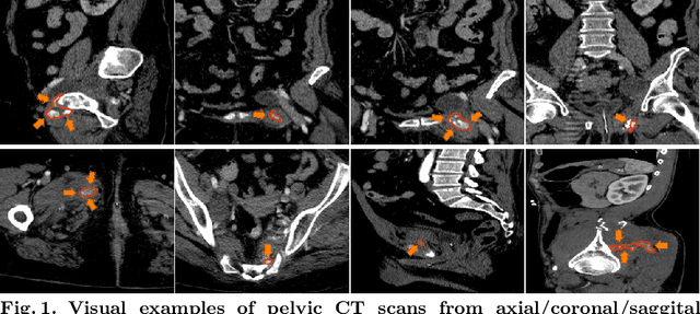 Figure 1 for Multi-Scale Attentional Network for Multi-Focal Segmentation of Active Bleed after Pelvic Fractures