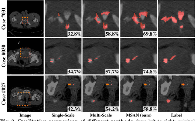 Figure 4 for Multi-Scale Attentional Network for Multi-Focal Segmentation of Active Bleed after Pelvic Fractures