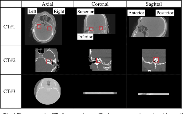 Figure 1 for Accurate Detection of Inner Ears in Head CTs Using a Deep Volume-to-Volume Regression Network with False Positive Suppression and a Shape-Based Constraint