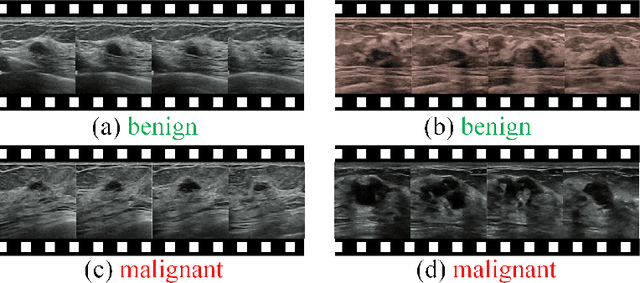 Figure 1 for Masked Video Modeling with Correlation-aware Contrastive Learning for Breast Cancer Diagnosis in Ultrasound