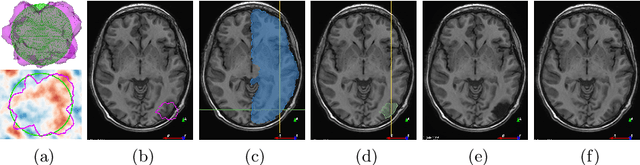 Figure 1 for Simulation of Brain Resection for Cavity Segmentation Using Self-Supervised and Semi-Supervised Learning