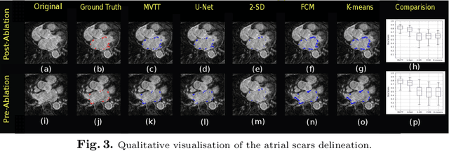 Figure 3 for Multiview Two-Task Recursive Attention Model for Left Atrium and Atrial Scars Segmentation
