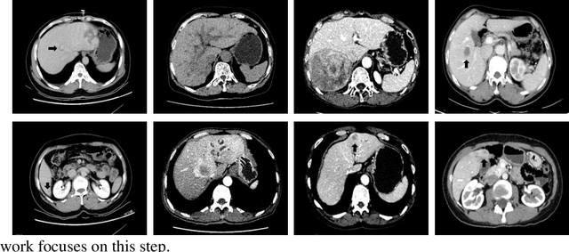 Figure 1 for Delving Deep into Liver Focal Lesion Detection: A Preliminary Study