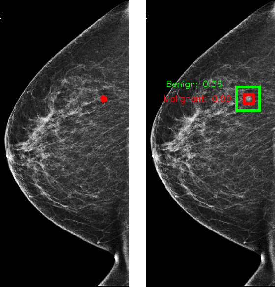 Figure 2 for Improving localization-based approaches for breast cancer screening exam classification