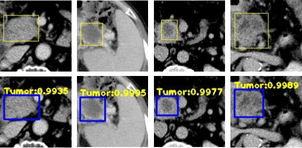 Figure 4 for A Novel and Efficient Tumor Detection Framework for Pancreatic Cancer via CT Images