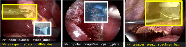 Figure 1 for Recognition of Instrument-Tissue Interactions in Endoscopic Videos via Action Triplets