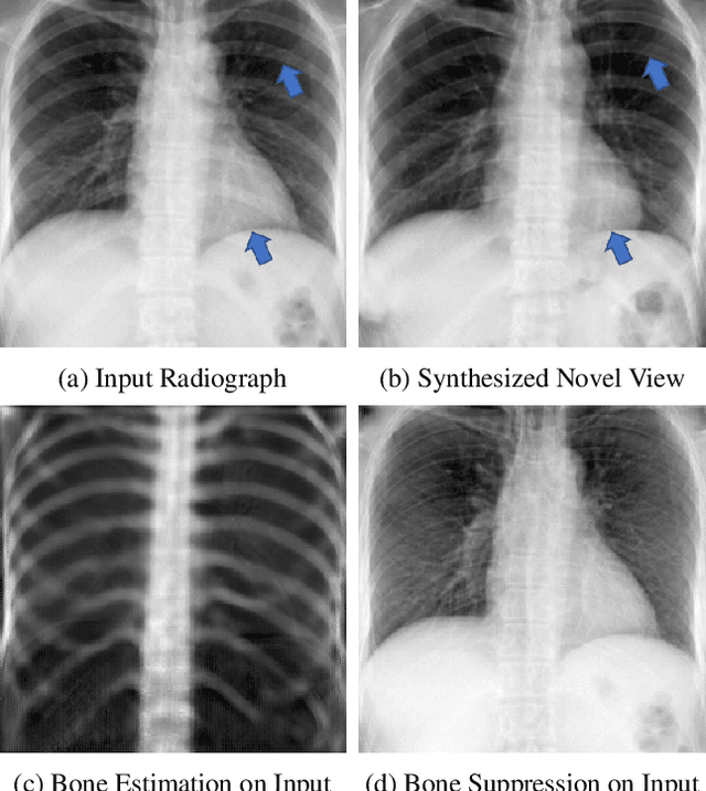 Figure 1 for XraySyn: Realistic View Synthesis From a Single Radiograph Through CT Priors
