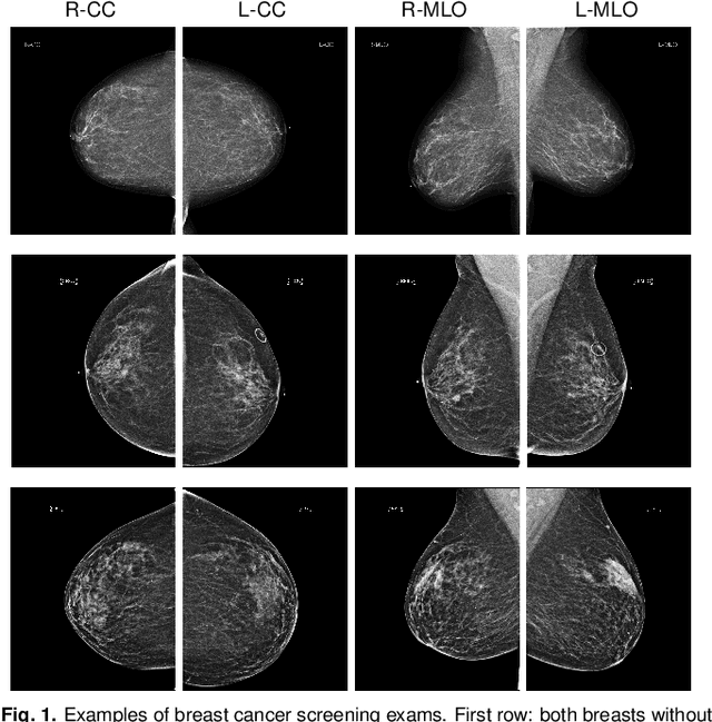 Figure 1 for Deep Neural Networks Improve Radiologists' Performance in Breast Cancer Screening