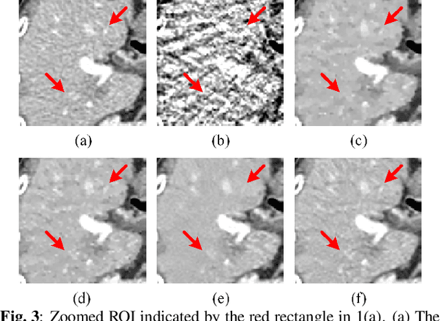 Figure 4 for Sparse-View CT Reconstruction via Convolutional Sparse Coding
