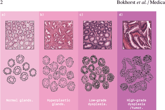 Figure 1 for Automated risk classification of colon biopsies based on semantic segmentation of histopathology images