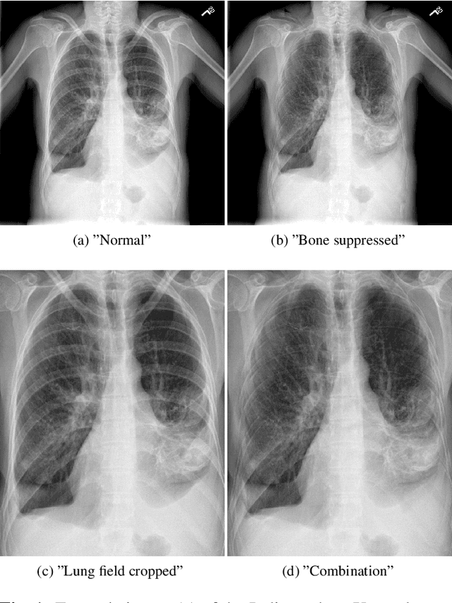 Figure 1 for When does Bone Suppression and Lung Field Segmentation Improve Chest X-Ray Disease Classification?