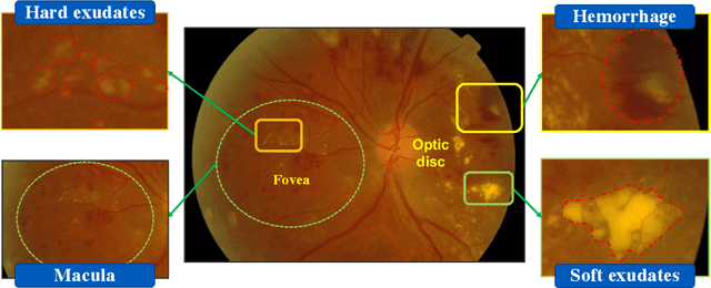 Figure 1 for Learning Robust Representation for Joint Grading of Ophthalmic Diseases via Adaptive Curriculum and Feature Disentanglement