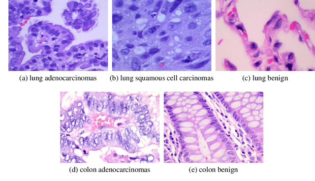Figure 1 for Convolution Neural Networks for diagnosing colon and lung cancer histopathological images