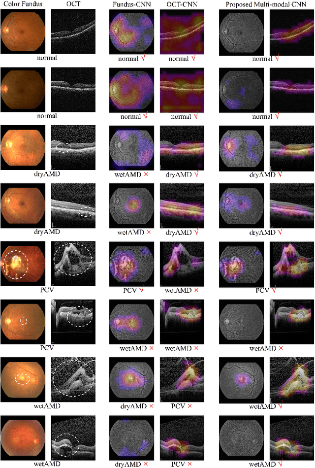 Figure 4 for Learning Two-Stream CNN for Multi-Modal Age-related Macular Degeneration Categorization