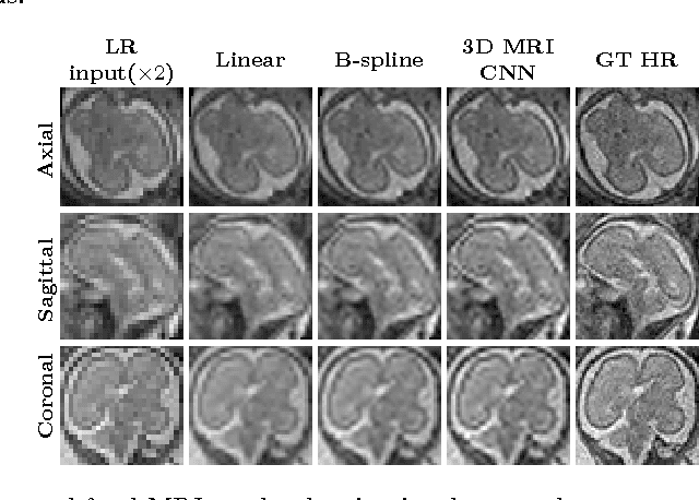 Figure 4 for Context-Sensitive Super-Resolution for Fast Fetal Magnetic Resonance Imaging