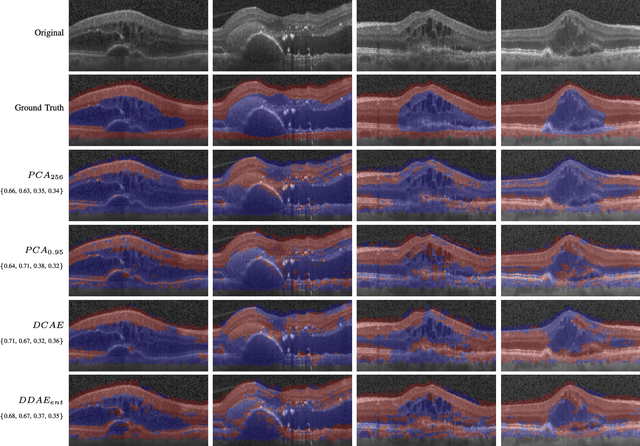 Figure 3 for Unsupervised Identification of Disease Marker Candidates in Retinal OCT Imaging Data