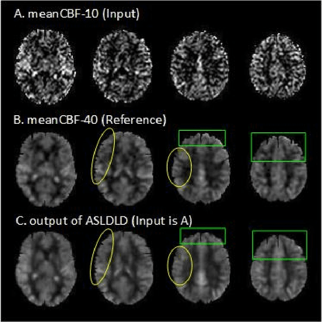 Figure 2 for Denoising Arterial Spin Labeling Cerebral Blood Flow Images Using Deep Learning