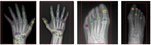 Figure 1 for Deep Learning for Rheumatoid Arthritis: Joint Detection and Damage Scoring in X-rays