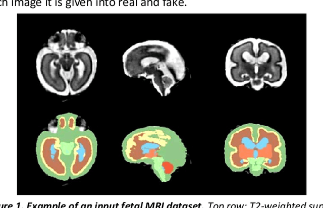 Figure 1 for Synthesis of realistic fetal MRI with conditional Generative Adversarial Networks