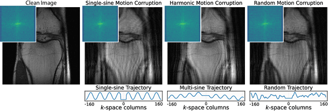 Figure 2 for Autofocusing+: Noise-Resilient Motion Correction in Magnetic Resonance Imaging