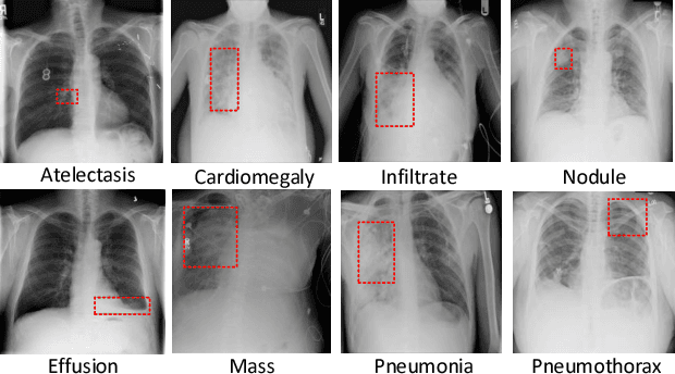 Figure 1 for Weakly Supervised Deep Learning for Thoracic Disease Classification and Localization on Chest X-rays