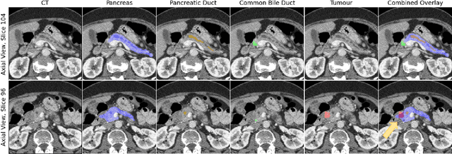 Figure 1 for Improved Pancreatic Tumor Detection by Utilizing Clinically-Relevant Secondary Features