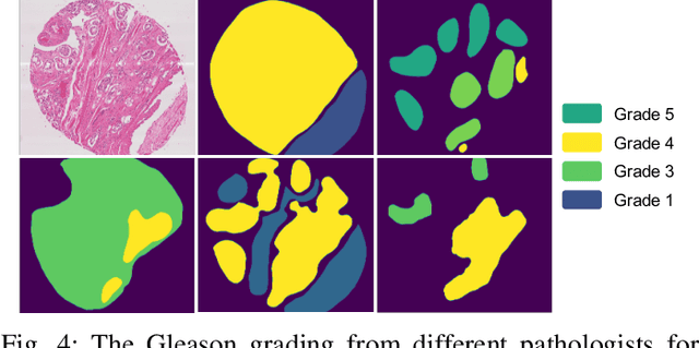 Figure 4 for Robust Medical Image Classification from Noisy Labeled Data with Global and Local Representation Guided Co-training