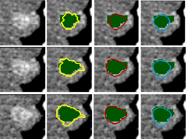 Figure 3 for Deep LOGISMOS: Deep Learning Graph-based 3D Segmentation of Pancreatic Tumors on CT scans