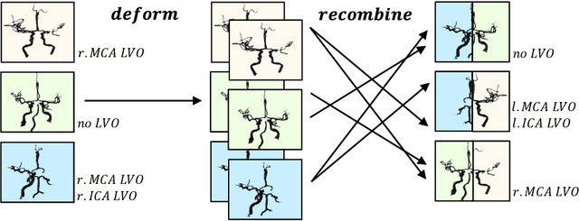 Figure 1 for Building Brains: Subvolume Recombination for Data Augmentation in Large Vessel Occlusion Detection