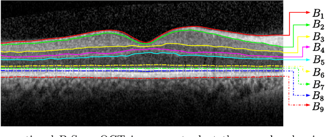 Figure 3 for Automated Segmentation of Retinal Layers from Optical Coherent Tomography Images Using Geodesic Distance